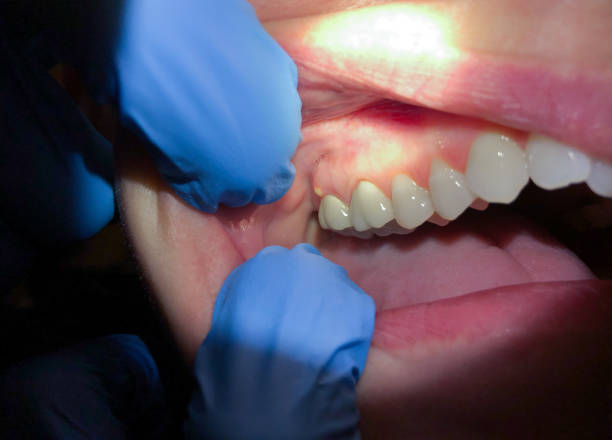 Emergency Treatment for Gum Disease